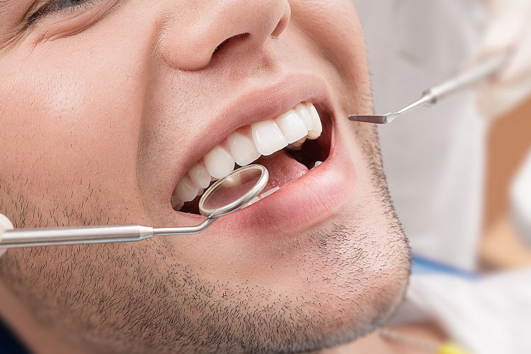 Porcelain veneers